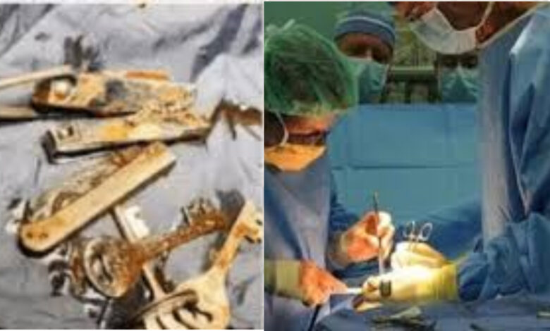 bihar doctor removed metal objects from youths stomach